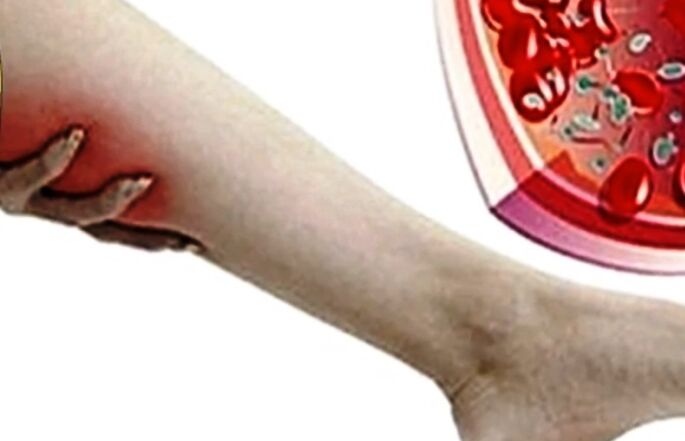 Κιρσοί φλέβες στο πόδι